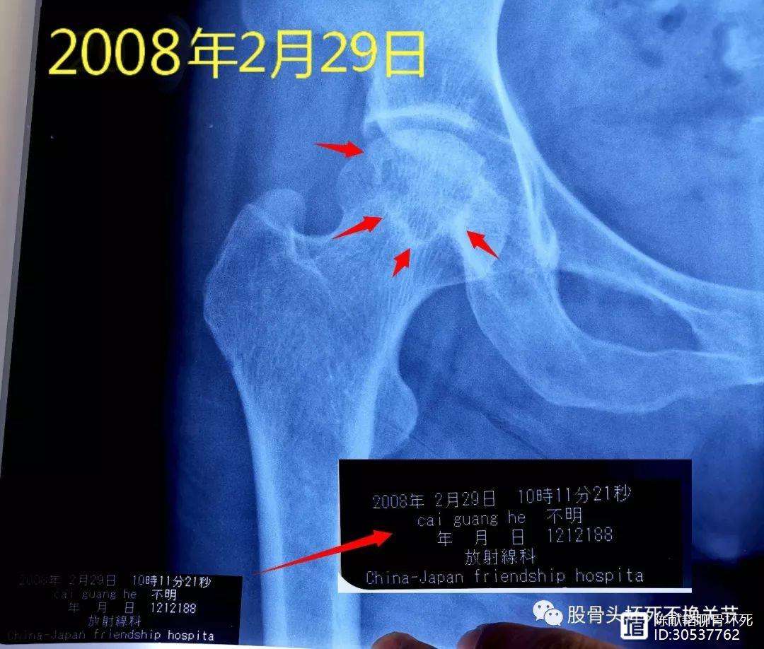 宿州人工骨头医保报销多少(人工骨头医保报销多少比例)
